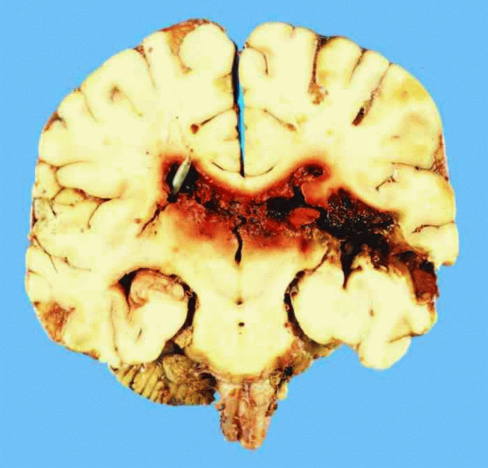 Figure 8.4 (top) Section of the brain of a 25-year-old construction worker who committed suicide with a stud gun pressed against the left temple. The nail projectile traversed the brain, lodging in the right lateral ventricle. The nail apparently tumbled upon entrance into the brain. Such suicides are uncommon but well known in the forensic community.